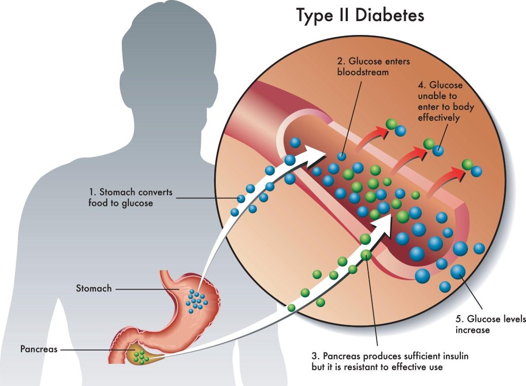 Cause of Type 2 Diabetes Singapore 