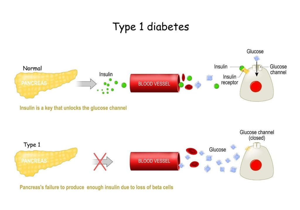 Cause of Type 1 Diabetes Singapore 