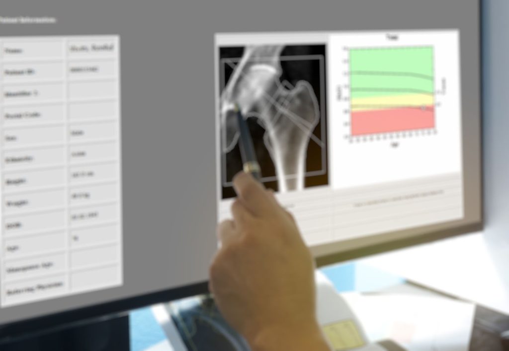 bone mineral density test singapore