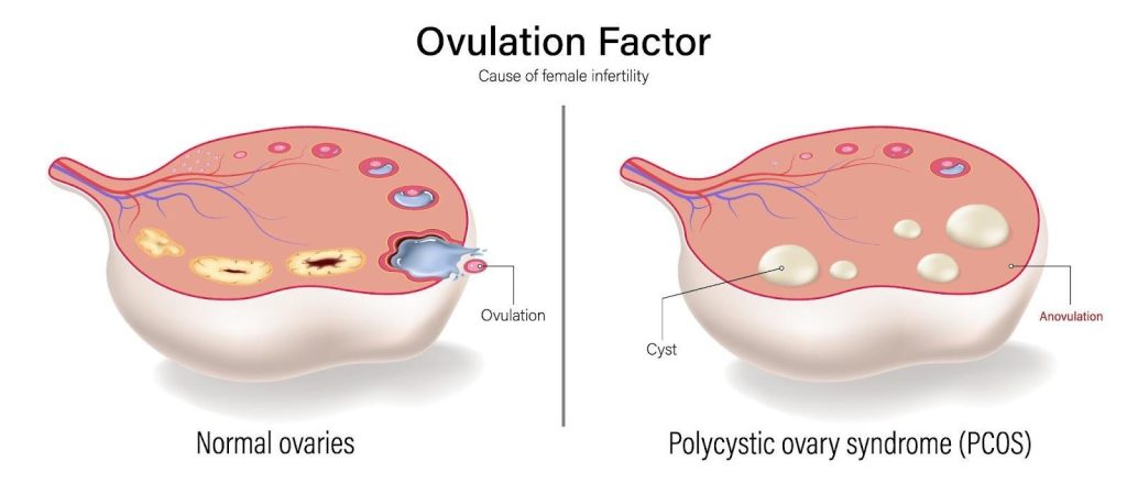 PCOS and Infertility Singapore