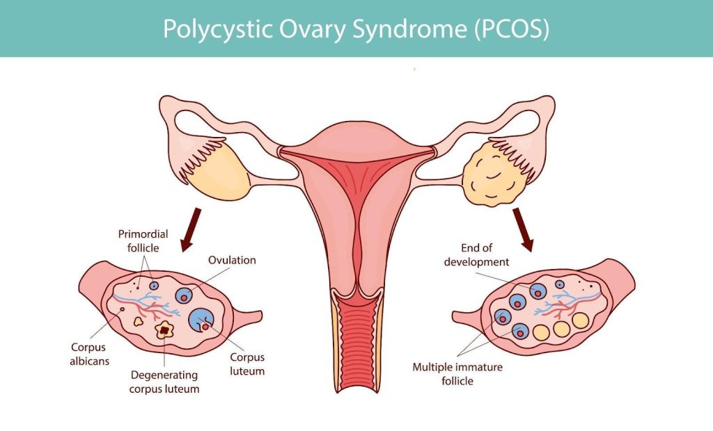 Polycystic Ovary Syndrome (PCOS) Singapore