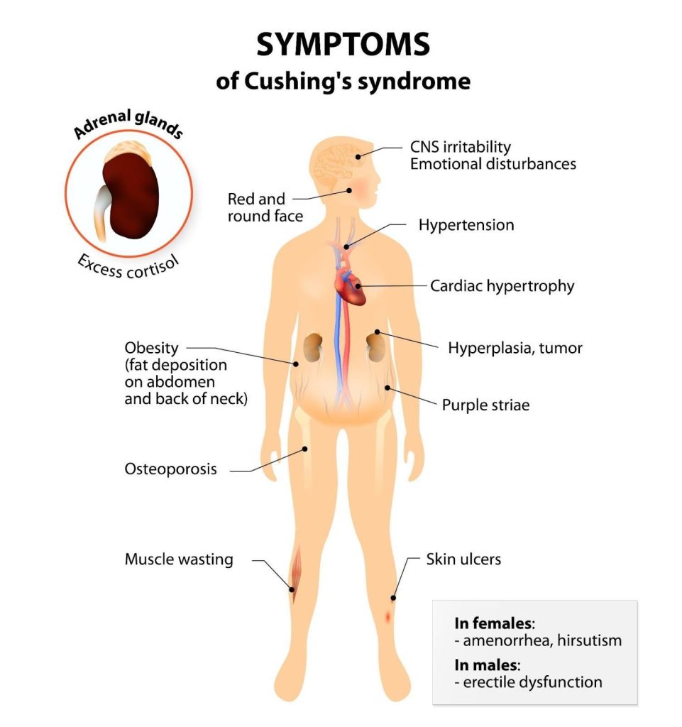 Symptoms of Cushing Syndrome Singapore