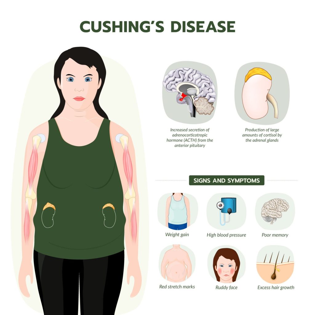 Cushing's Disease Singapore