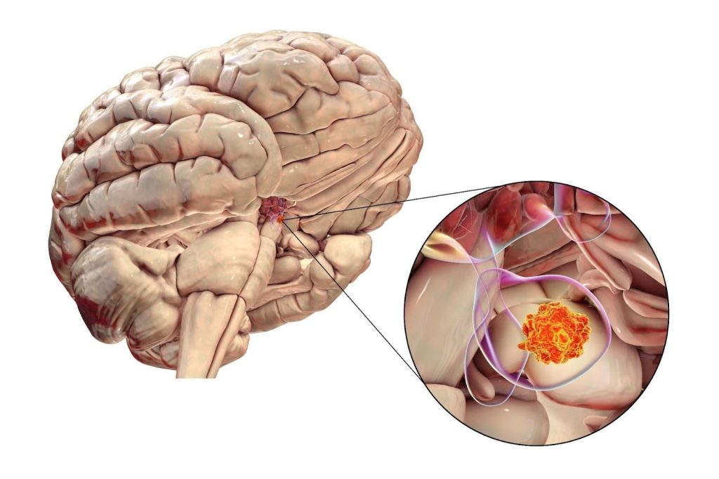 Prolactinoma Singapore