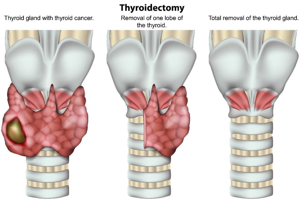 thyroid cancer treatment options Singapore.