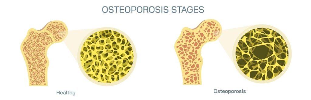 Osteoporosis Singapore