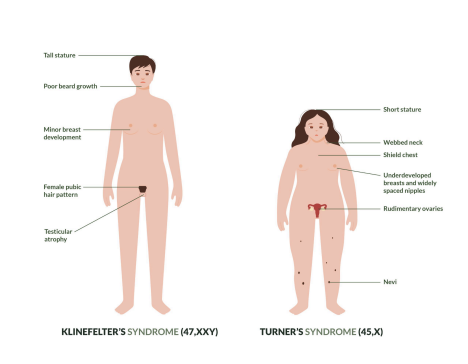 Klinefelter’s and Turner’s syndrome singapore