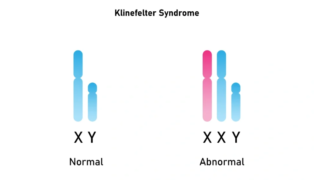 Klinefelter’s Syndrome Singapore