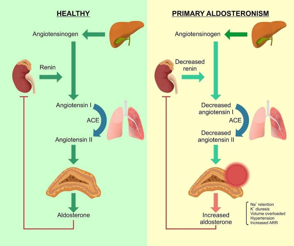 Primary hyperaldosteronism Singapore
