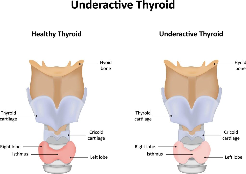 Thyroid Hormone Replacement for Hypothyroidism Singapore