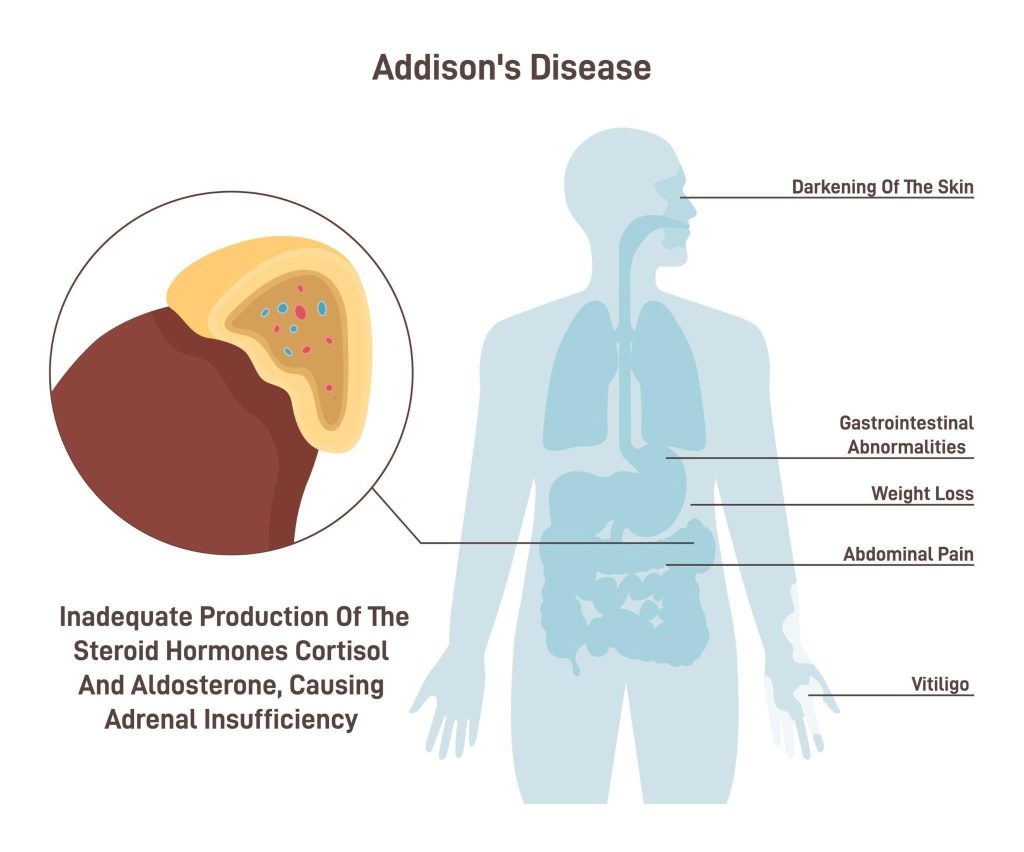 Adrenal Hormone Replacement for Addison’s Disease Singapore