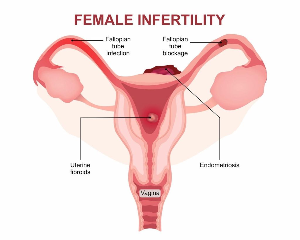 Female Infertility Singapore