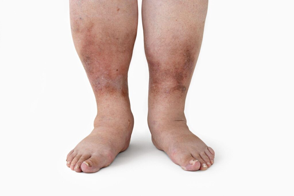 Symptoms of Diabetic Nephropathy Singapore