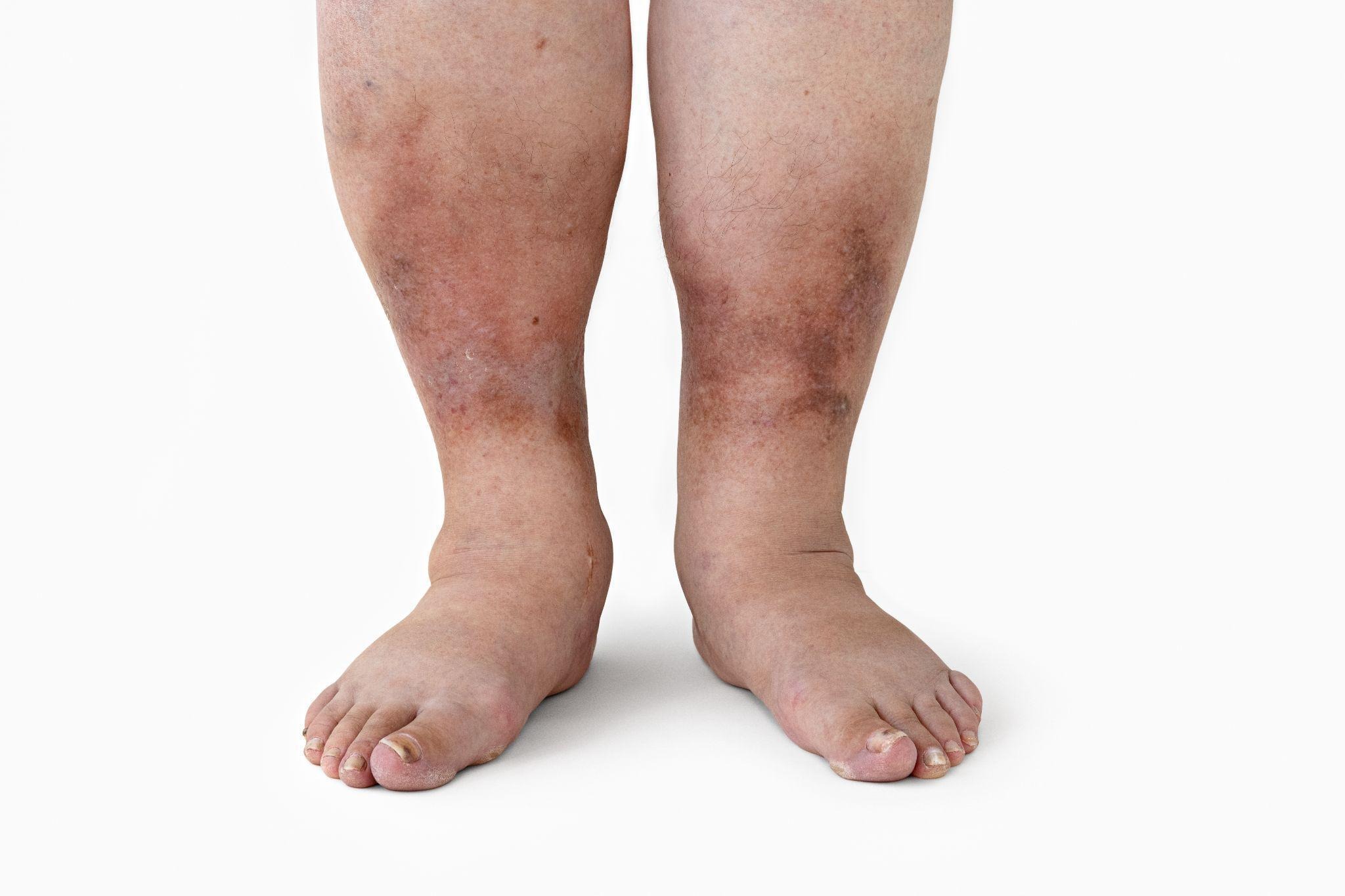 Symptoms of Diabetic Nephropathy Singapore