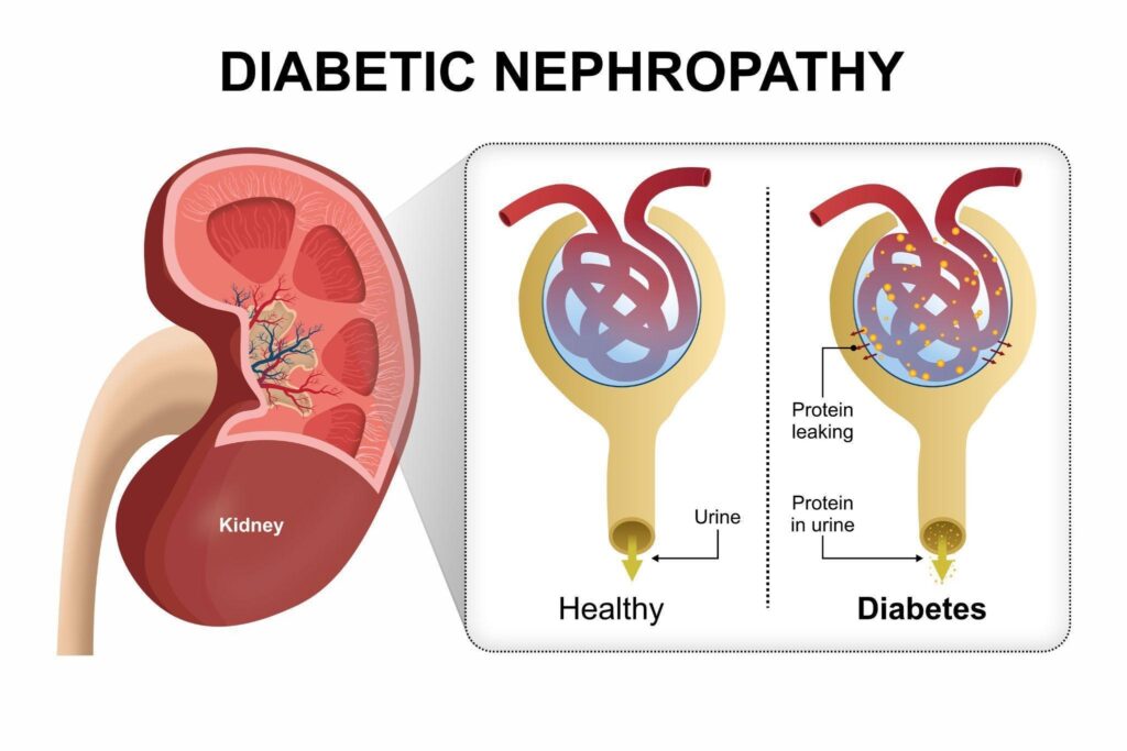 How Does High Blood Sugar Damage the Kidneys Singapore