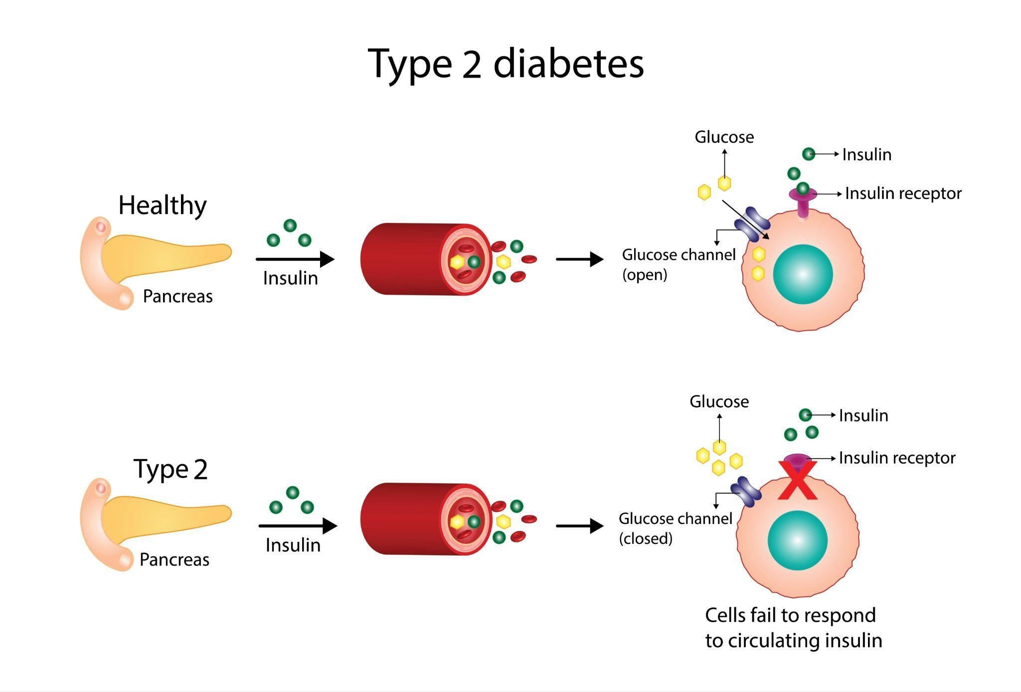 Type 2 Diabetes Singapore